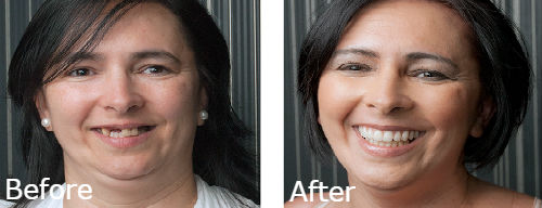 dental-implant-ba10-min