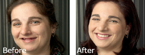 dental-implant-ba5-1-min